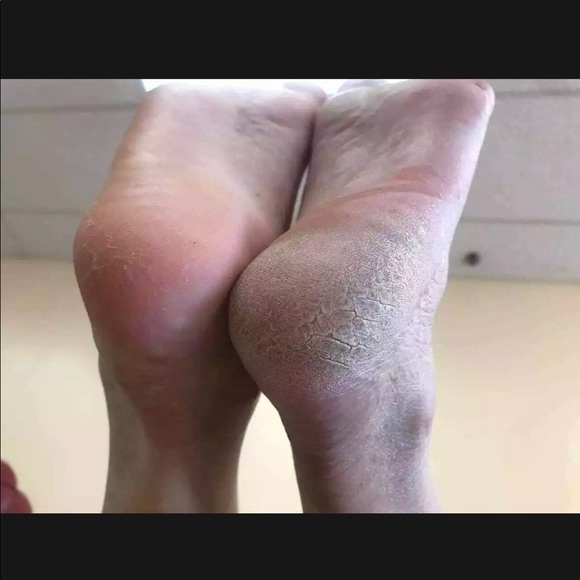(1) Epoch Foot Treatment Sole solution - Picture 2 of 8